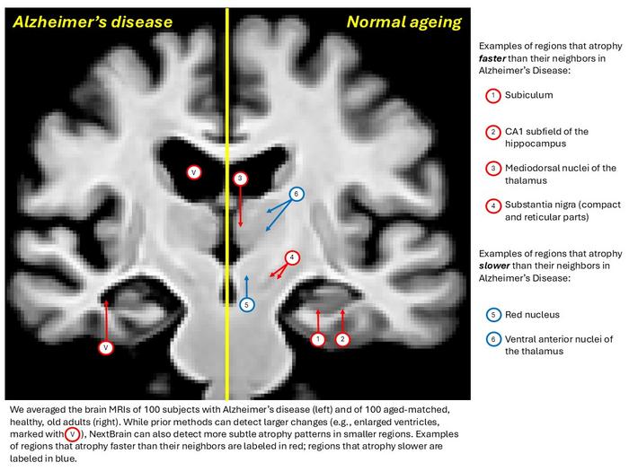 Alzheimers v normal ageing MRI