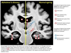 Alzheimers v normal ageing MRI