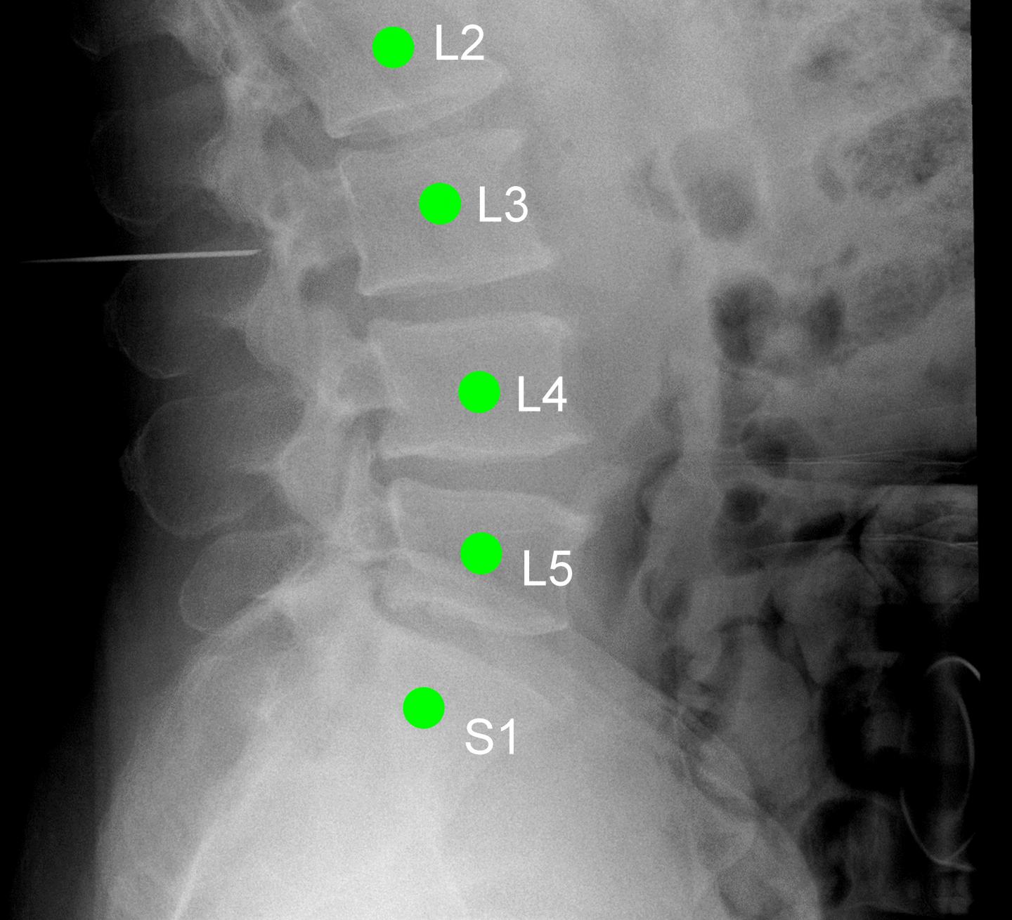 New Software Labels Patients' Vertebrae before Spine Surgery
