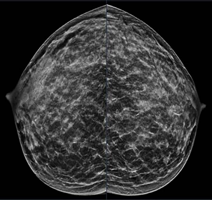 Extremely dense breast tissue is noted on mammography