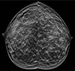 Extremely dense breast tissue is noted on mammography