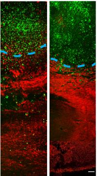 Imipramine Blue on Tumor Invasion