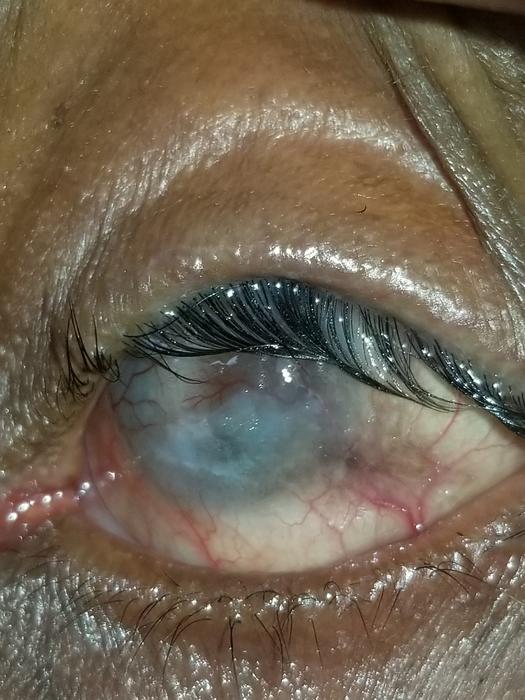 Trachomatous Trichiasis Severe Case