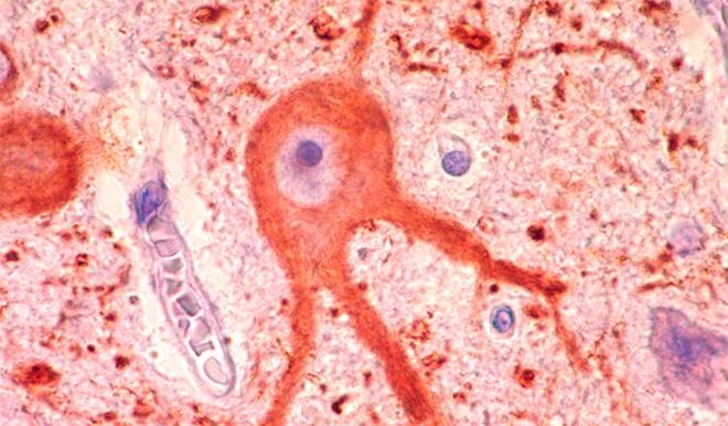 A Dysmorphic Neuron Stained with MAP2 Neuronal Antibody