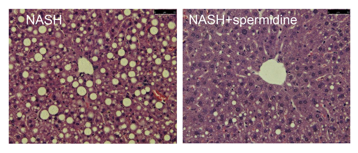 Spermidine reduces steatosis in the liver