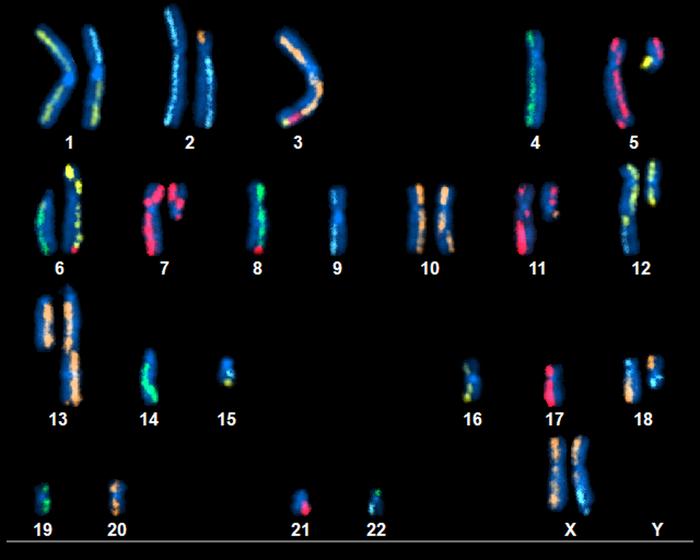 Pancreatic Cancer Cell Chromosomes