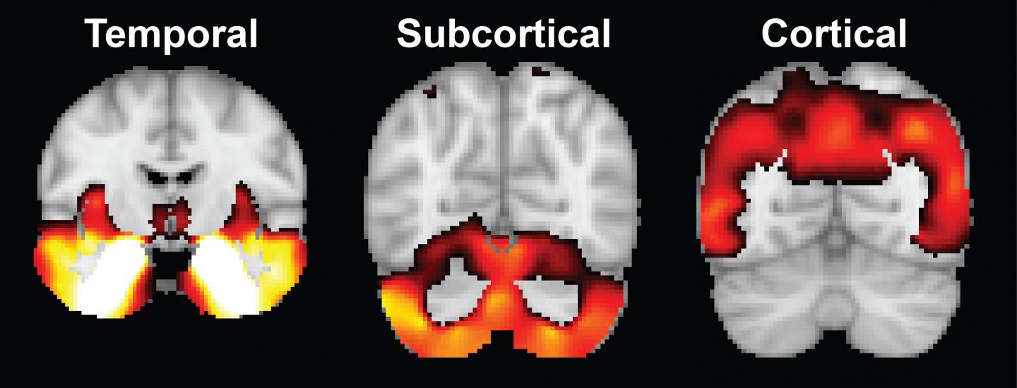 Alzheimer's Disease Atrophy Factors