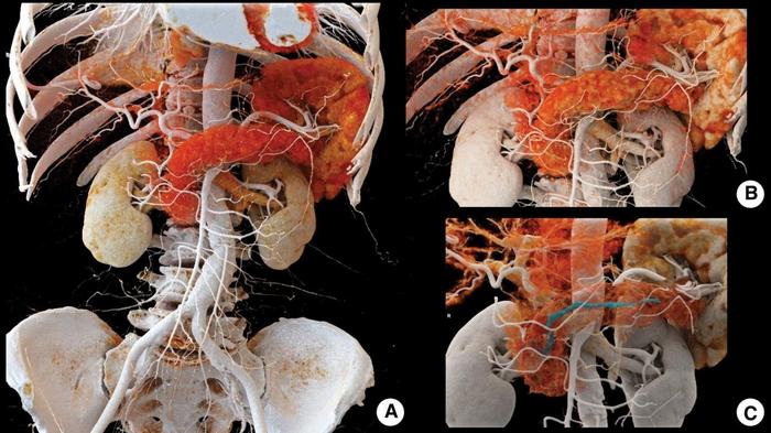 A 61-year-old female with a suspected pancreatic head mass. Arterial-phase PCCT data (0.4 mm slice thickness) were post-processed using CR