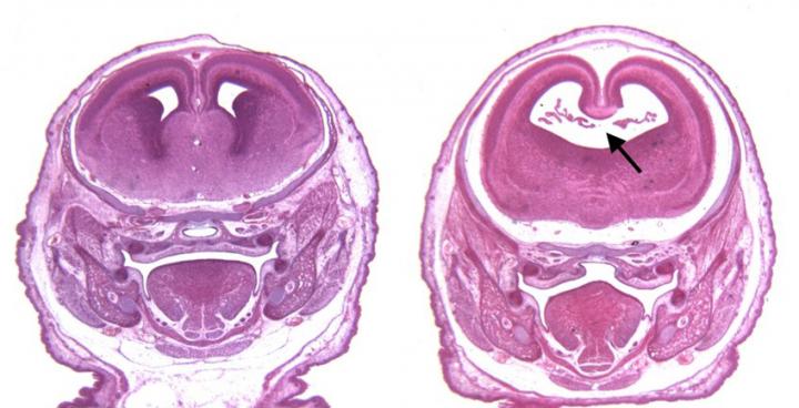 Cannabinoids Exacerbate Alcohol-Induced Brain Defects.