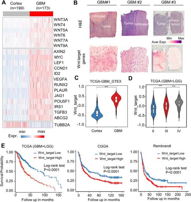Overexpression of Wnt target genes positively correlates with glioma grade and predicts worse patient survival.
