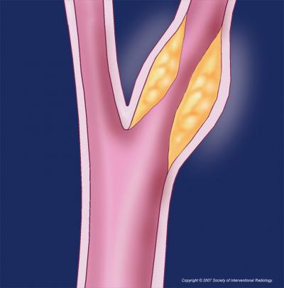 Blocked Carotid Artery