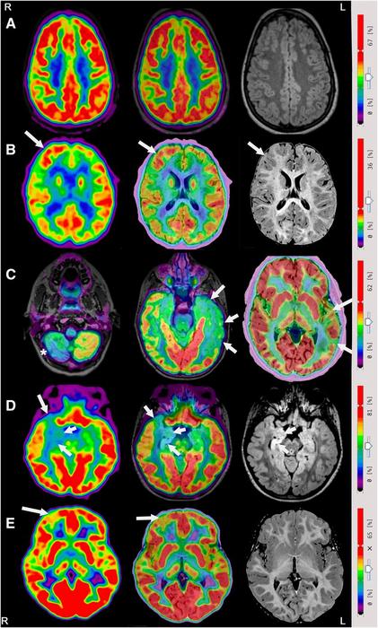 [18F]FDG PET/MRI in Pediatric Focal Epilepsies