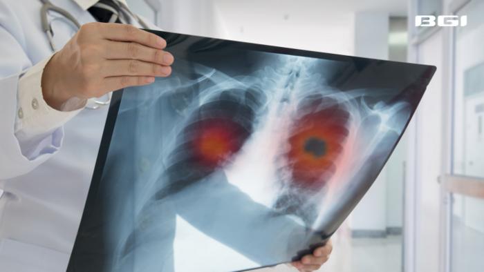 BGI Genomics mNGS detects 3x more lung pathogens than CMTs