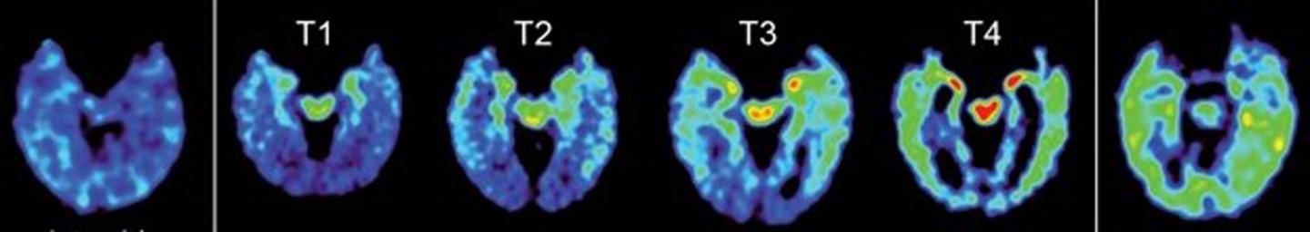 Four Stages of Abnormal Brain Protein Deposits