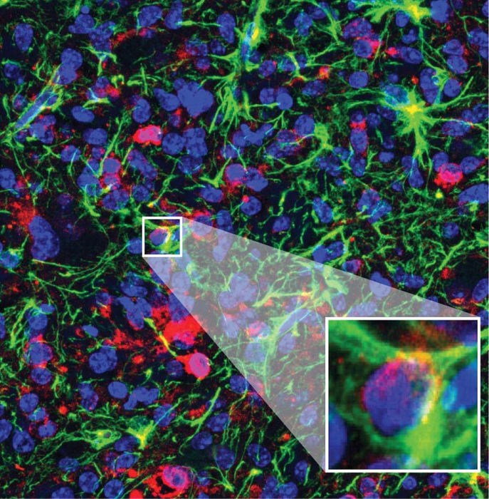 Glioma Zoom