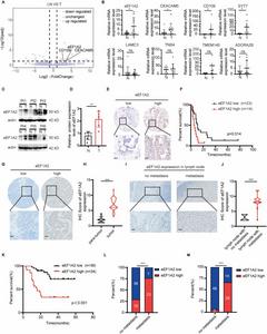 eEF1A2 is tightly correlated with lymph node metastasis and poor prognosis in patients with GBC.