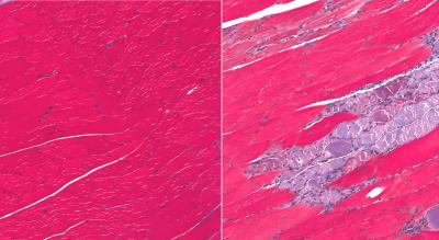 Muscular Dystrophy