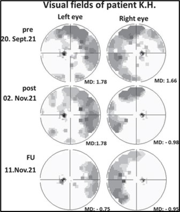 Visual fields of patient K.H.
