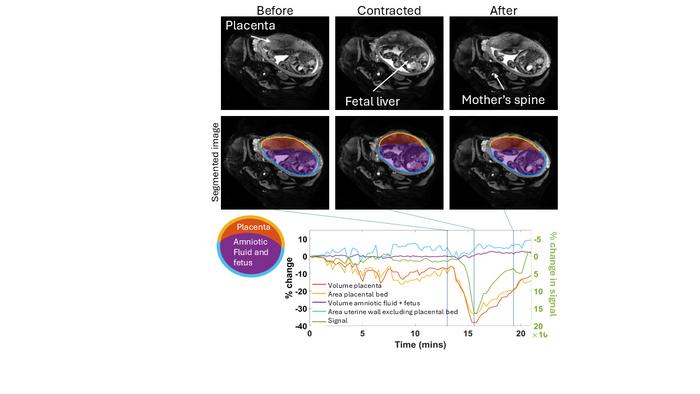 MRI images showing placental contractions