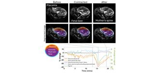 MRI images showing placental contractions