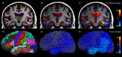 MRI Brain Scans