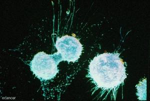 New Precision Medicine Approach Identifies a Promising Ovarian Cancer Treatment