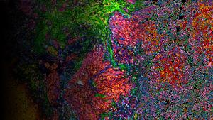 Multiplex immunofluorescence imaging of a head and neck cancer tissue sample