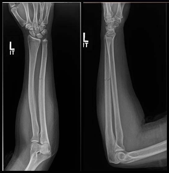 Forearm Fractures May Signal Intimate Partner Violence