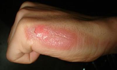 Skin Burn