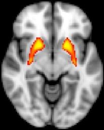 Dysfunction in Striatum