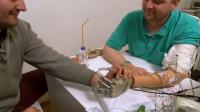 Amputee Feel in Real-Time with Bionic Hand