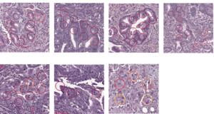 Examples of different tumour cell types