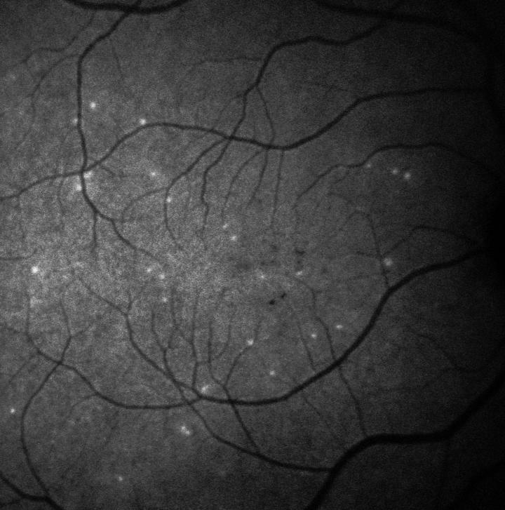 Retina of Glaucoma Patient Using DARC Test