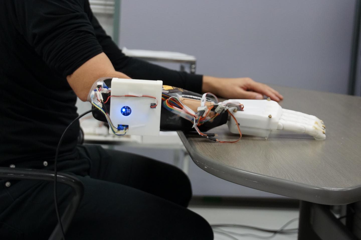 The prosthetic hand and socket