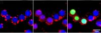 Death of Brain Cancer Cells after Photodynamic Therapy