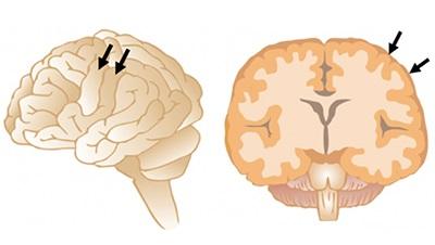 Figure 1. Gyri on the Brain Surface (Arrows)