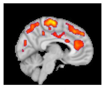Neuroinflammation in the Brains of Patients with Fibromyalgia