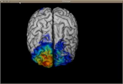 Cortex Lesions