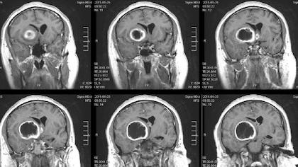 Brain Tumor