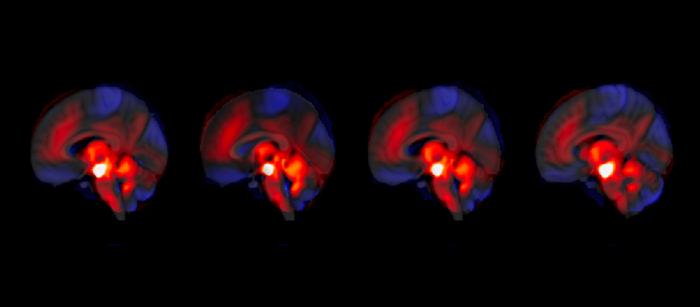 Schizophrenia: The cerebellum’s unexpected role