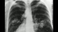 Powerful One-Two Punch Targets Lung Cancer