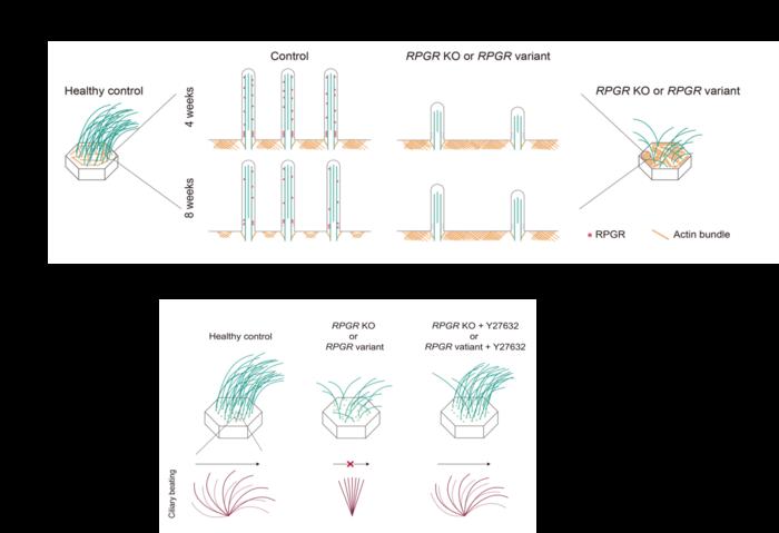 The multiciliated cells from patients with RPGR variants have sparse, short, and mostly static cilia. These defects can be ameliorated by treatments that disrupt F-actin accumulation.