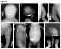 UMA Researchers Identify a Rare Genetic Bone Disorder through Massive Sequencing Methods
