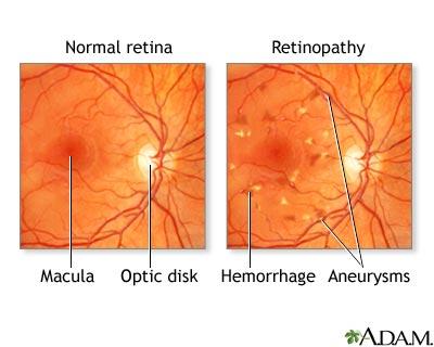 Retinopathy