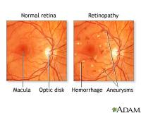 Retinopathy