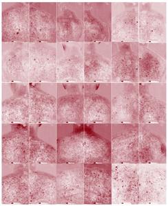 VISIA-CR imaging of truncal acne