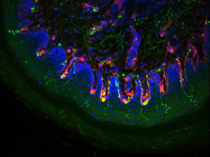 Potential Relief from Diabetic Nerve Pain (1 of 1)