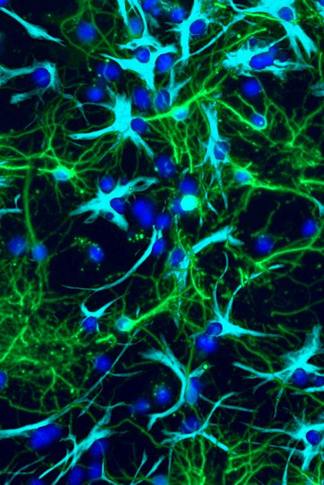 Study sheds light on how pediatric brain tumors grow