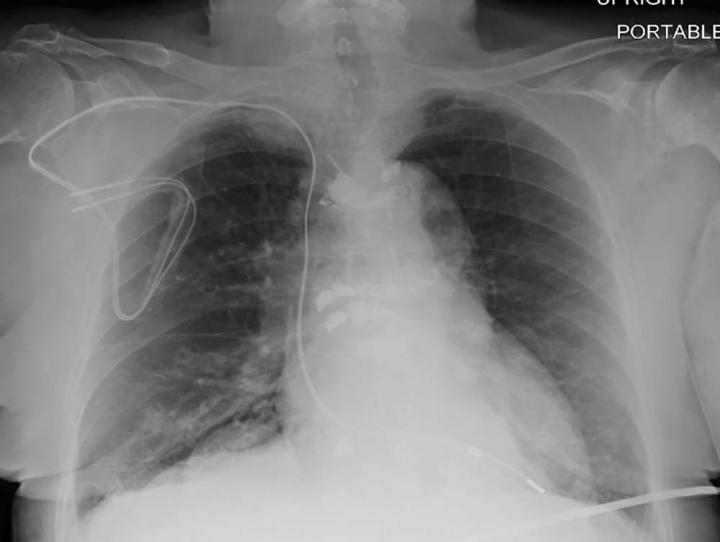 MRI Safely Performed in Patients with Pacemakers and ICDs