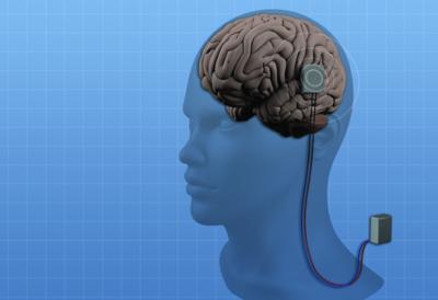 Epilepsy Implant